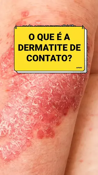 Dermatite de Fraldas