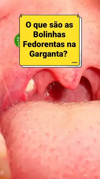 Bolinhas na garganta: tudo que você precisa saber