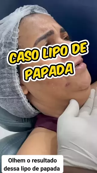 Lipo de Papada Mecânica 3D