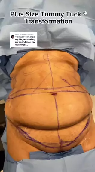 Before & After a Plus Size Tummy Tuck (Dr. Repta) 