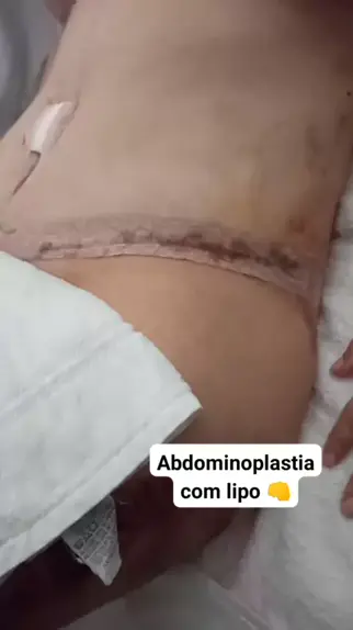 Abdominoplastia / Lipoabdominoplastia