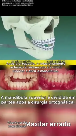 Mordedor Exercitador de Maxilar Modelador Facial e de Harmonização de,  mandibula e maxilar 