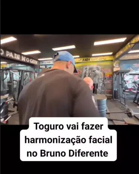 Ex-participante do 'BBB 23' faz harmonização facial; confira