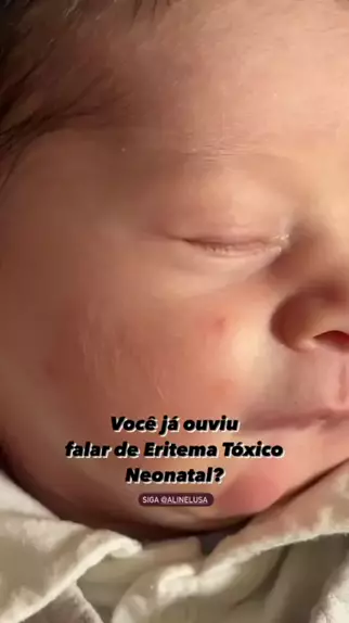 eritema tóxico neonatal