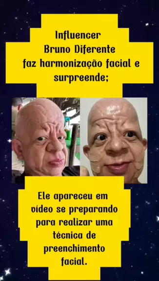 Influencer Bruno Diferente faz harmonização facial e surpreende