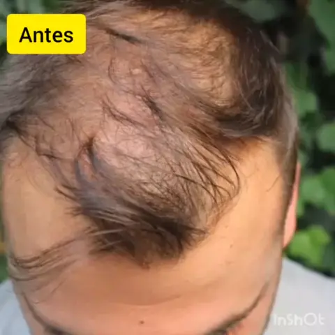 Como aplicar minoxidil sem desperdício! #minoxidil #cabelos #hair