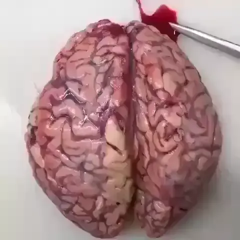 Rafael Couto573 Rafadebrito9 . udio original criado por Rafael Couto573. Hemorragia intracerebral descoberta durante aut psia cerebral ap s a vacina. Os co gulos de sangue v o para o c rebro