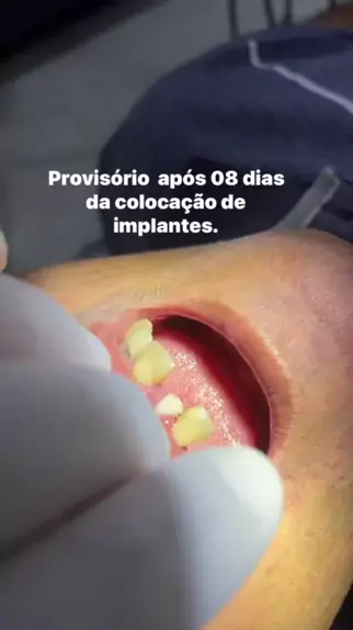 Invisalign - Basílio Bernal