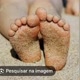 aleania bicho  pé e cravos e espinha