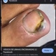 unhas encravadas