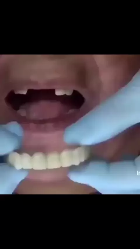 Dentadura ajustável